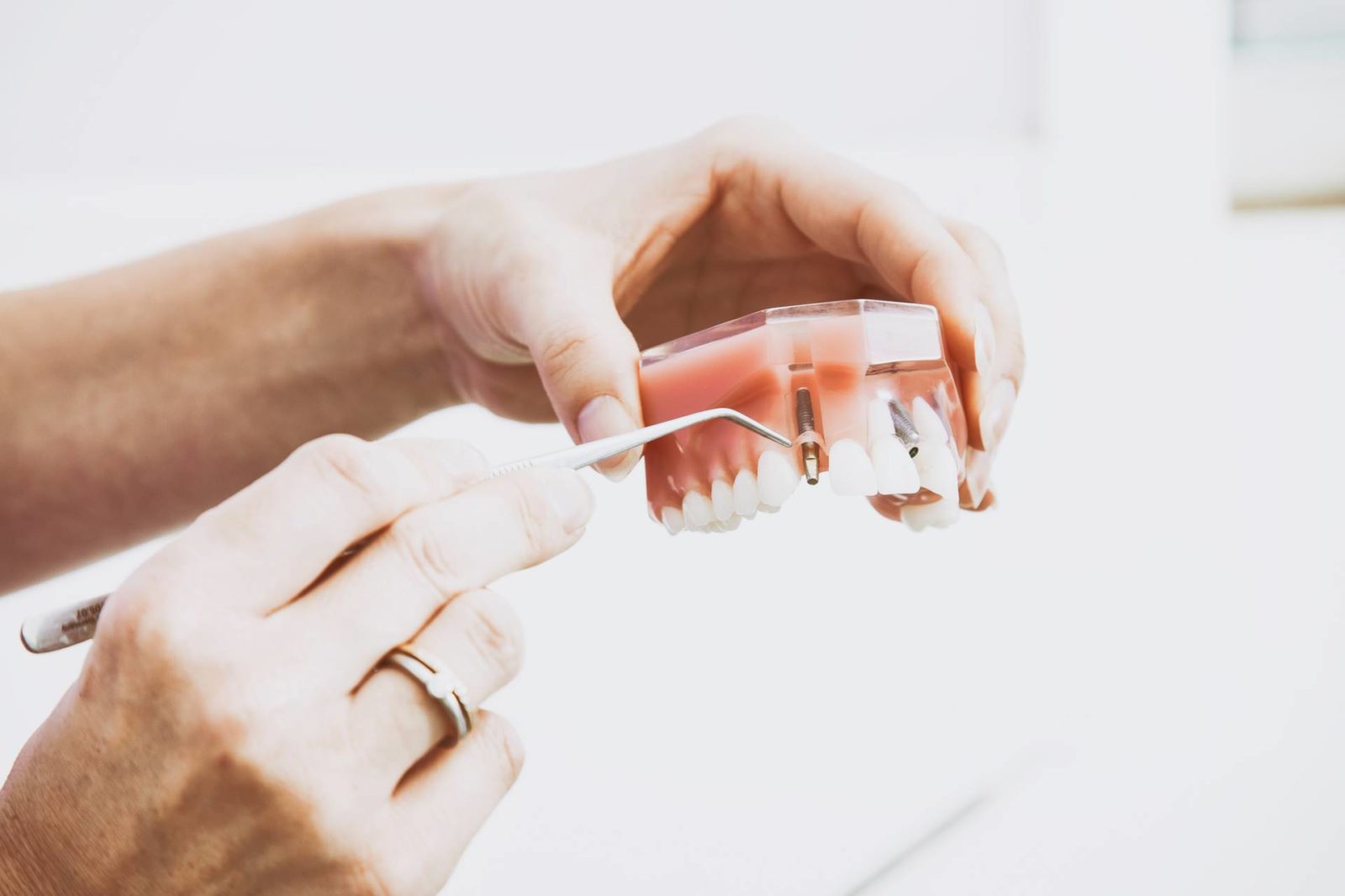 High-Quality Biocompatible Materials used for Dental  Implants